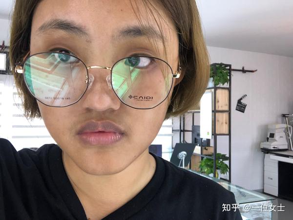 记录吃激素满月脸的恢复状况