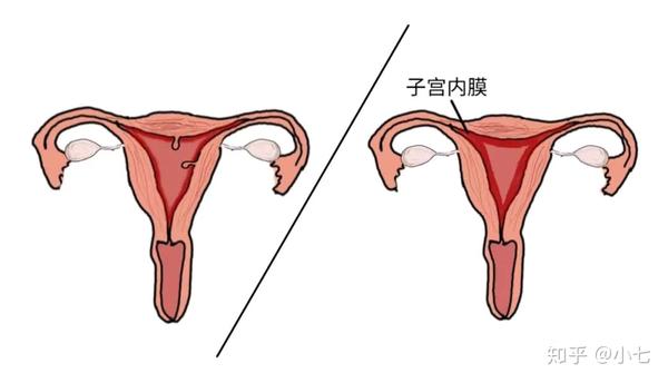 子宫内膜出问题了 月经血主要