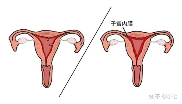 子宫内膜增生及息肉