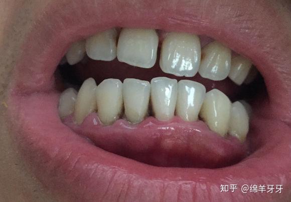 牙龈和牙齿之间有清晰的黑三角