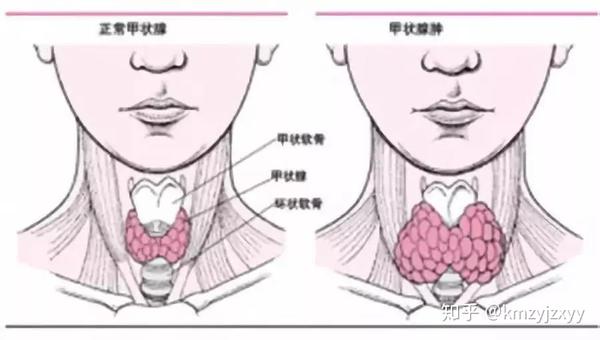 甲状腺疾病有不同,这6个区别,教你分清甲亢,甲减和甲状腺结节