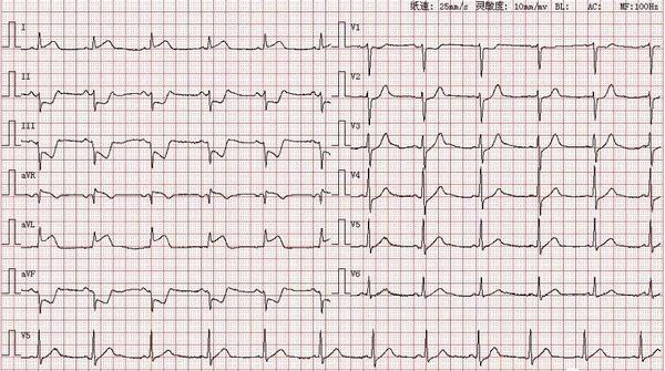 心电图图库丨心肌梗死系列