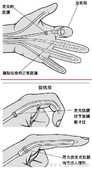 先天性拇指狭窄性腱鞘炎一定要手术吗?2岁以内可以保守治疗!