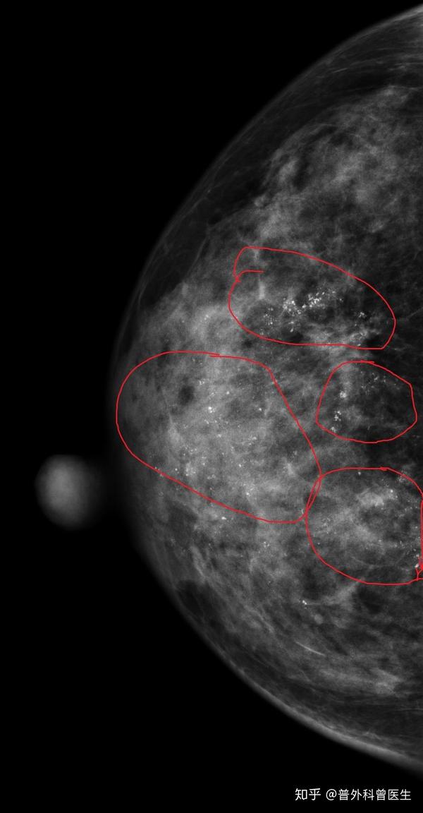 由于钼靶的检查非常典型,完全符合乳腺癌的特征, 放射科医生直接报告