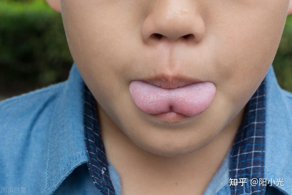 陷阱2"大舌头"口齿不清,多数和舌系带有关,不如早点给宝宝剪舌系带