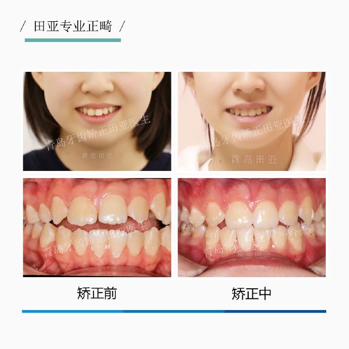 青岛牙齿矫正隐形牙套案例前牙开颌矫正不再为咬不断面条而困扰