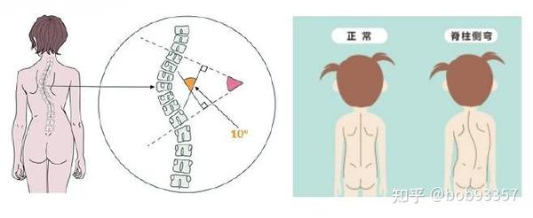 孩子双侧肩部一高一低警惕脊柱侧凸