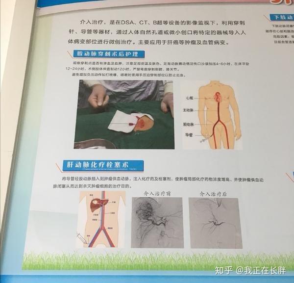 手术前要备皮,不能穿内衣裤.