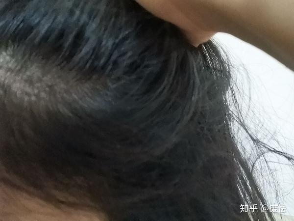 记录一下脂溢性脱发女生用米诺地尔的过程