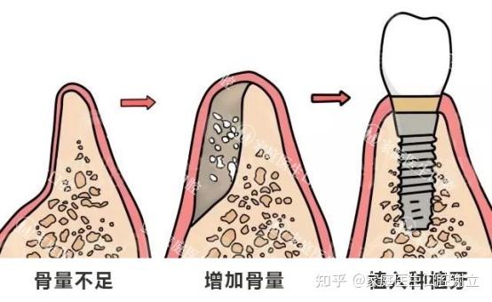 因为牙槽骨被吸收,会使牙槽骨骨量不足,导致无法支撑