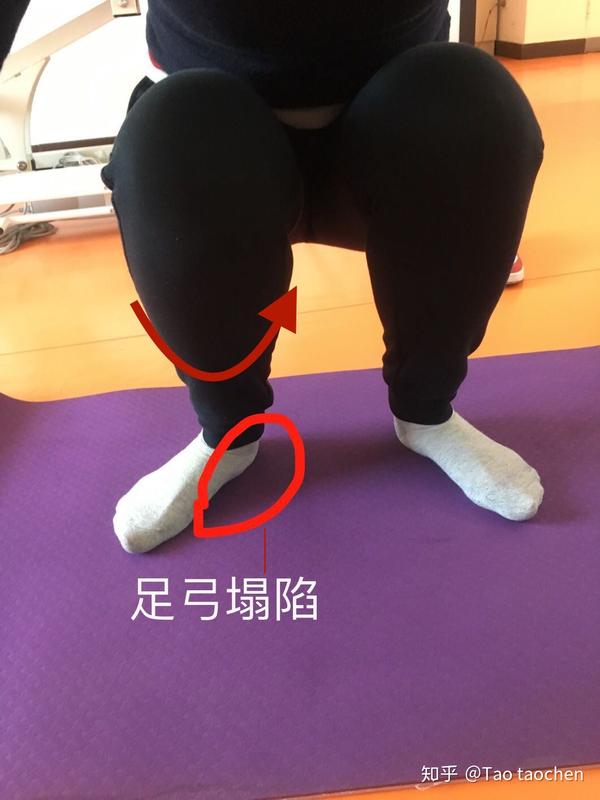 脚和膝盖不在一条力线上容易造成膝关节的损伤,小腿会内旋大腿外旋