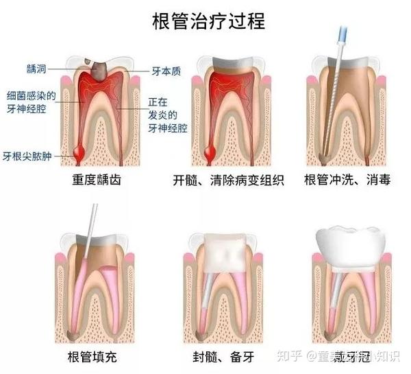 关于根管治疗,你需要知道的那些事