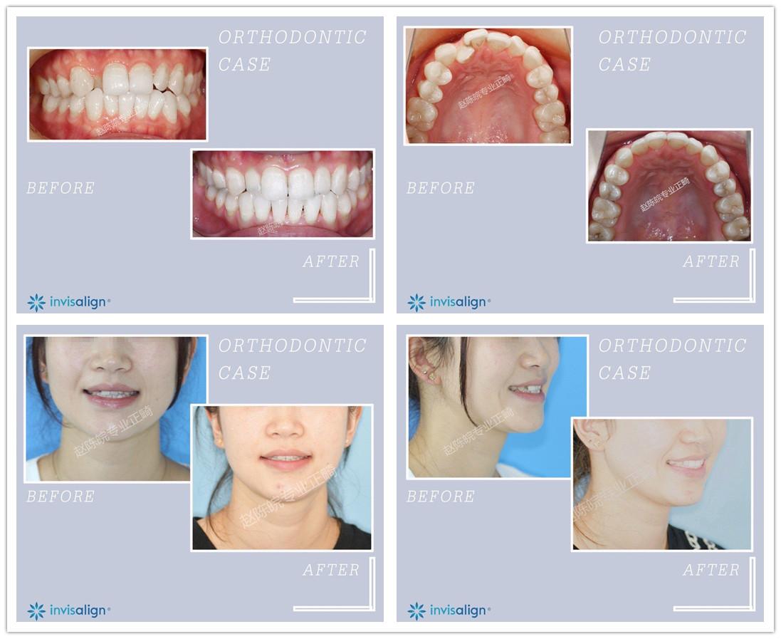 杭州牙齿矫正隐形隐适美矫正对脸型的改变真的很大吗