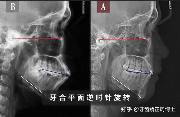 患者存在的问题是: 高角面型前突且开牙合 下巴严重后缩 方案通过拔牙