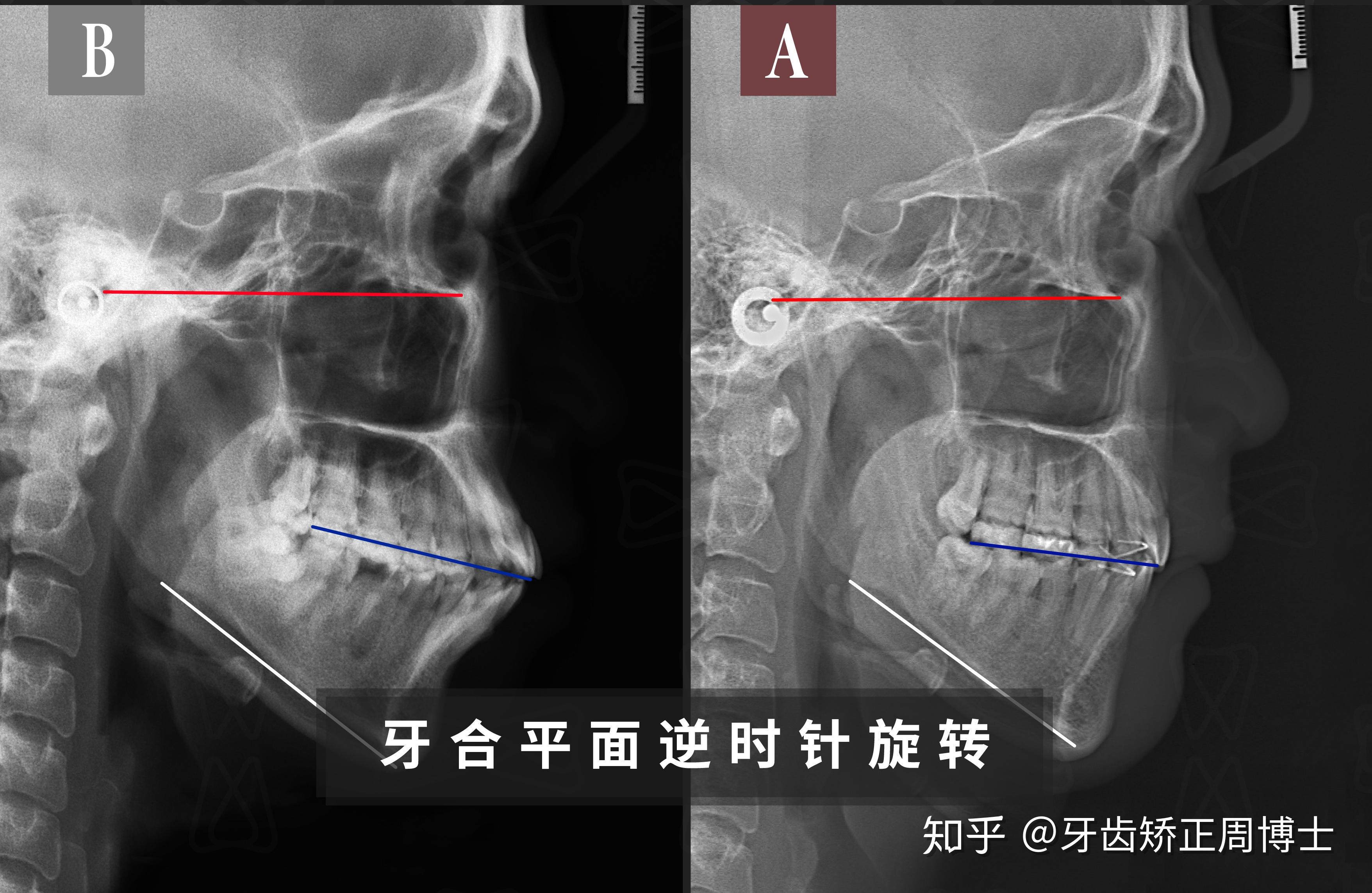 患者存在的问题是:高角面型前突且开牙合 下巴严重后缩方案通过拔牙