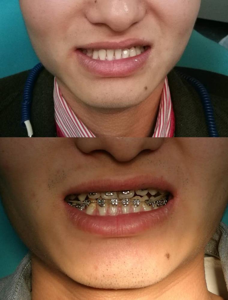 在合肥的牙科医院做的牙齿矫正对比效果如图,之前是地包天,还有点偏颌