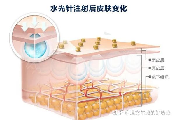 为什么1次水光针管理相当于4000次普通护理皮肤管理