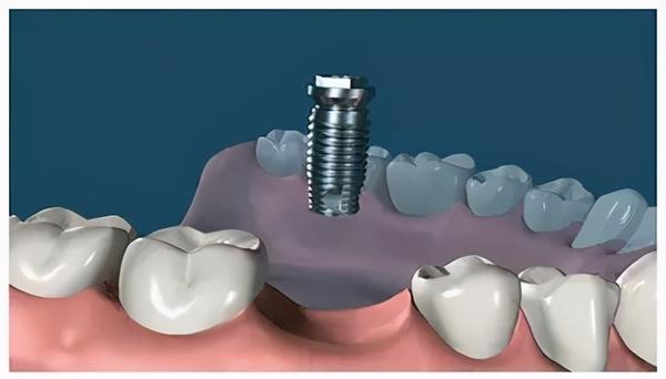 而缺牙后旁边的牙齿也会逐渐松动,脱落 这个时候,我们想到了 种植牙