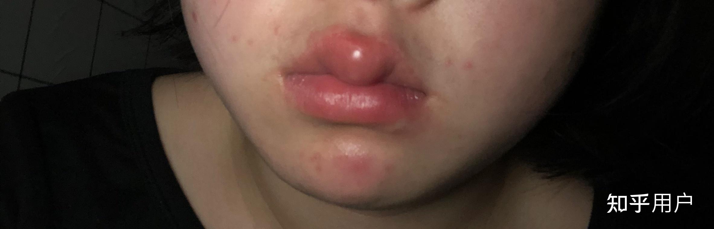 嘴唇被蚊子了然后肿了一个很大的包怎么办