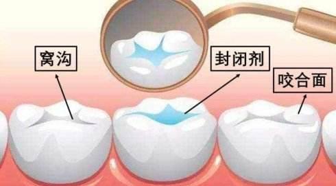 预防儿童龋齿涂氟和窝沟封闭