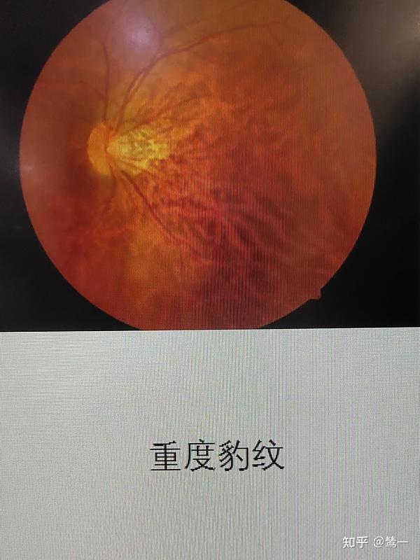 解析-眼底之豹纹状视网膜