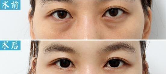 下眼袋皮肤松驰是做填充还是去皮?