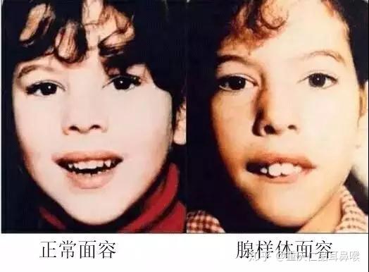 什么是扁桃体?