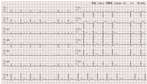 心电图图库丨二度ii型21房室传导阻滞系列