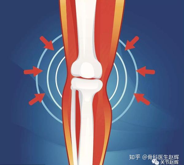 赵医生告诉你为什么关节一动就响