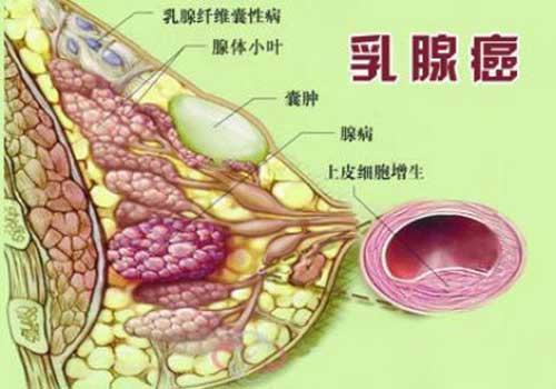 乳腺癌的综合治疗模式是什么?