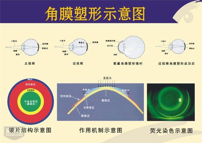 青岛近视矫正角膜塑形镜佩戴切忌停停戴戴