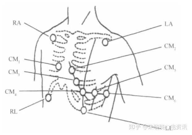 ra 位于右锁骨中线第2 肋 la 位于左锁骨中线第2 肋 ll 位于左