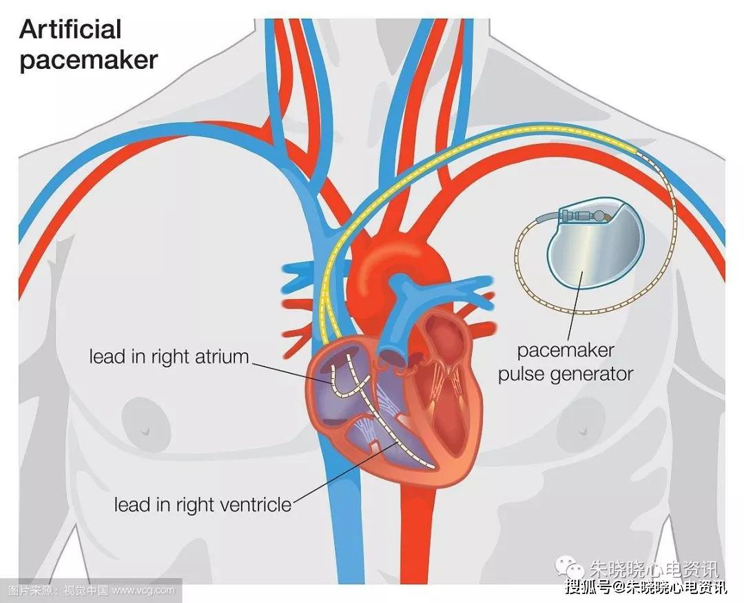 临床02奋起搏之心脏起搏器植入的三剑客