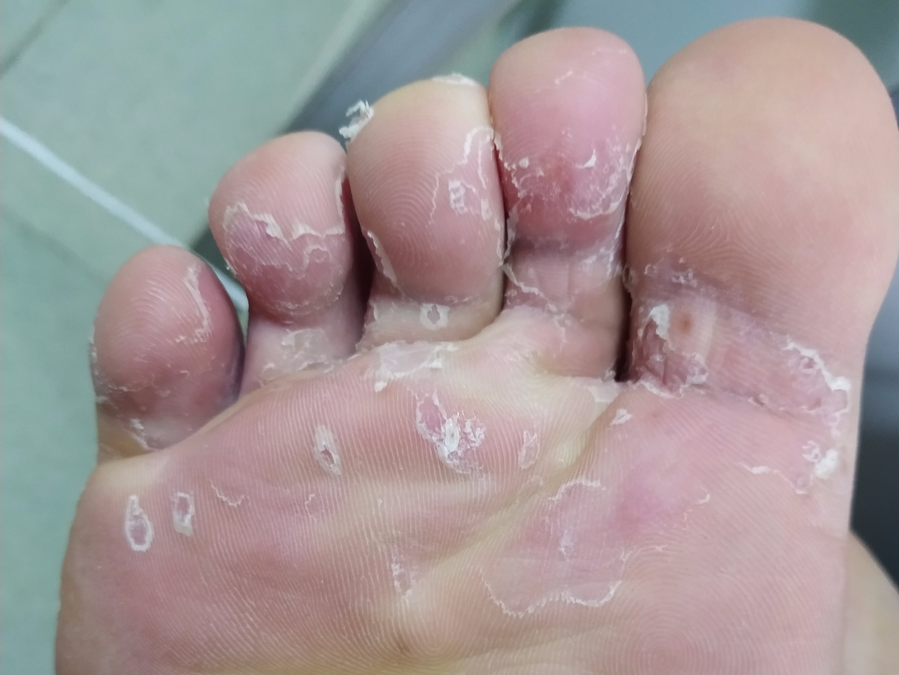 运动摩擦造成皮损这时便很容易感染真菌,造成糜烂型脚气,瘙痒感很强烈