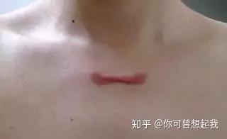 北京广济医院特邀疤痕专家周高峰为您解惑手术疤痕的危害及分类