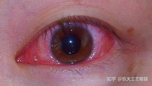 就很容易引发角膜炎和眼角滤泡以及眼睛血丝等症状