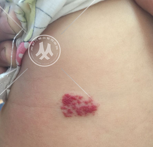 宝宝皮肤上出现凸出的红斑这可能是血管瘤在作祟
