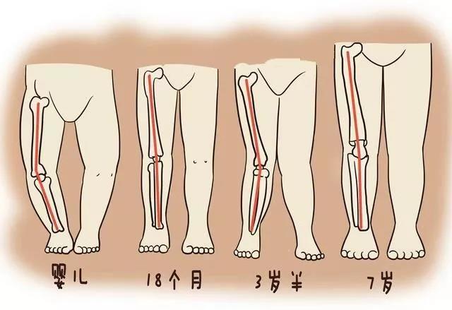 "o"型腿,"x"型腿详解及矫正方案