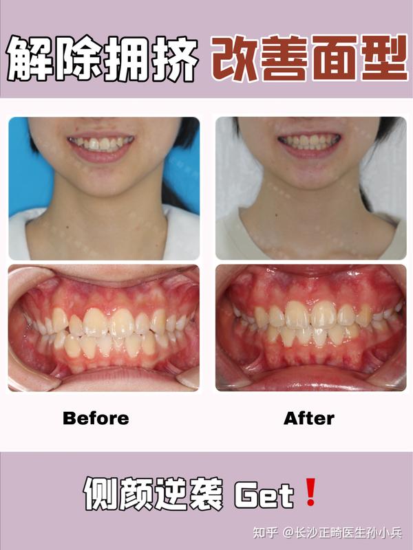 长沙牙齿矫正丨正畸案例17岁女孩牙列拥挤面形前突整牙后侧面立体微笑