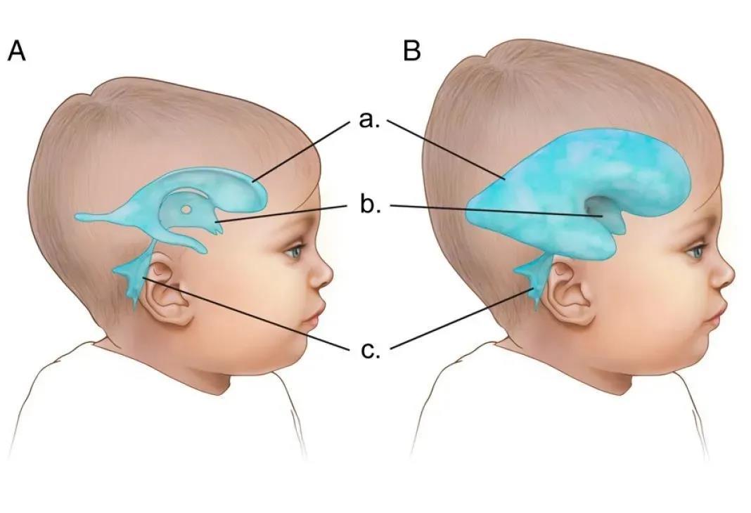 婴幼儿脑积水有哪些症状
