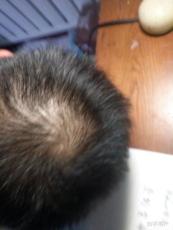 有人用过米诺地尔这种生发药物吗?有用吗?
