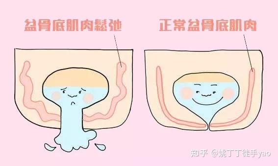 产后盆底肌修复是骗人还是真有用