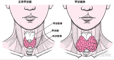 它的诊断完全是靠手摸的,同时在b超的"火眼金睛"下,再小的甲状腺结节