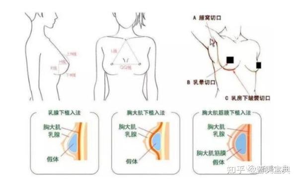 假体隆胸切口优劣势对比