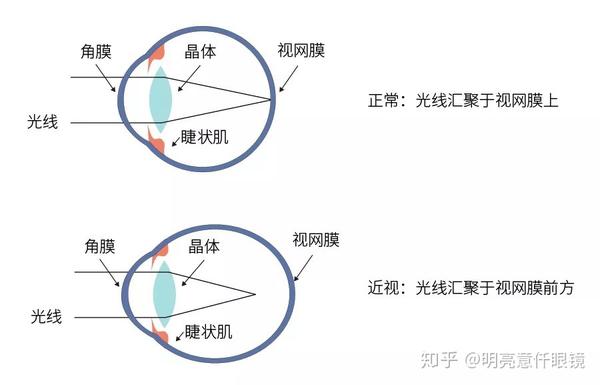 假性近视和真性近视,你分得清楚吗?