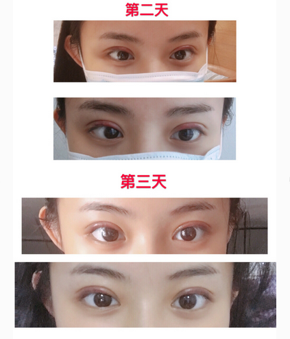 做双眼皮失败过的医生,看看有你种草的