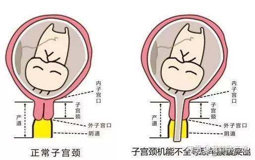 2 常无明显子宫收缩痛而颈管消失,羊膜囊突出 3 非孕期时,可将8号宫颈