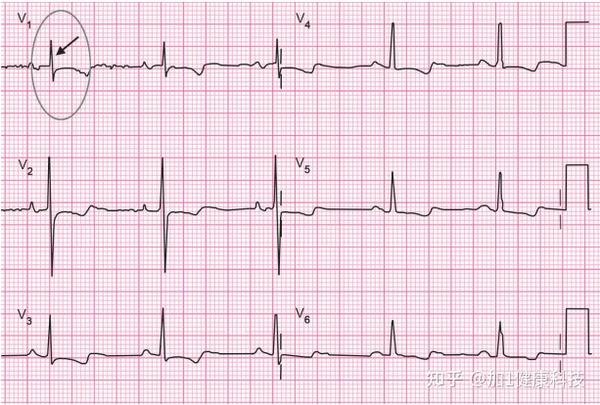 右心室肥厚的心电图
