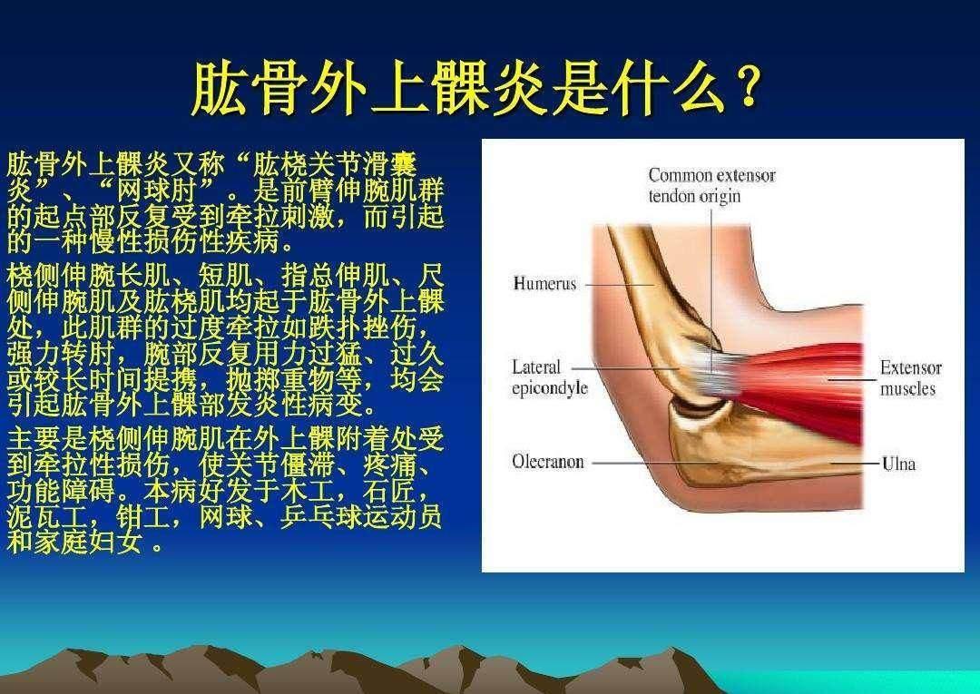 羽毛球"网球肘"的表现以及防治