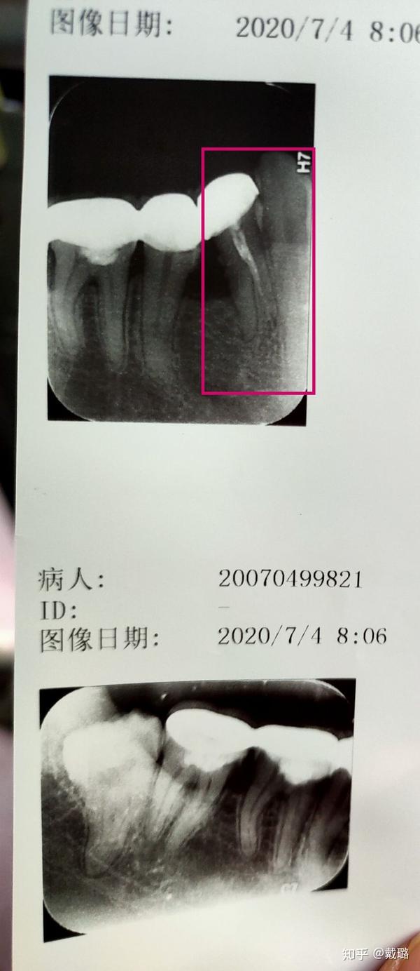 医生说根管治疗也不彻底,需要二次治疗,另外四个搭桥的烤瓷牙今天也拍